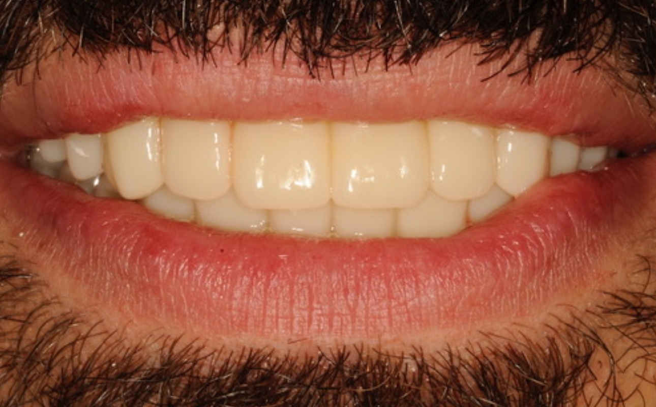 prima e dopo - studio dentistico lattanzi (1)