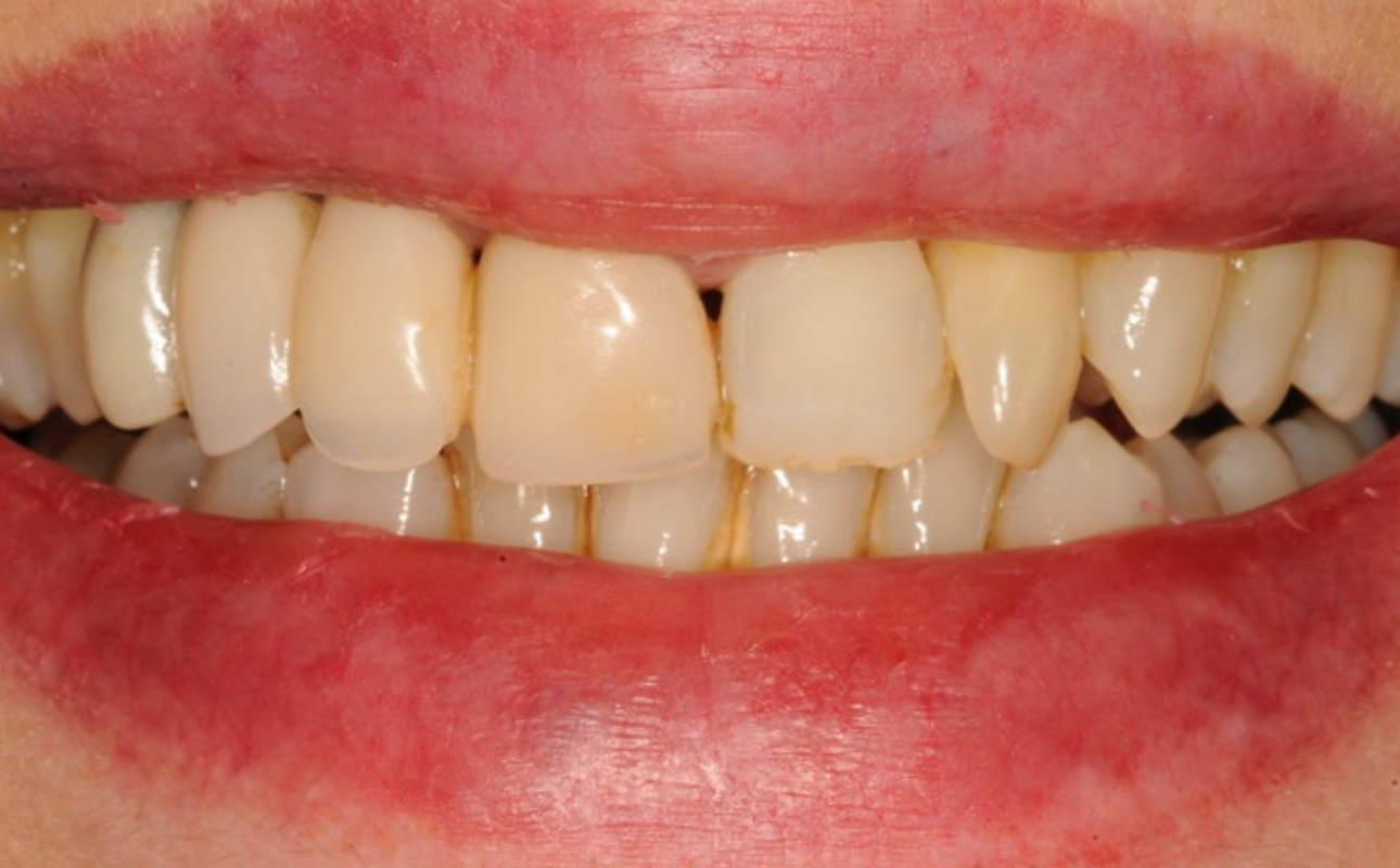 prima-e-dopo-studio-dentistico-lattanzi (1)