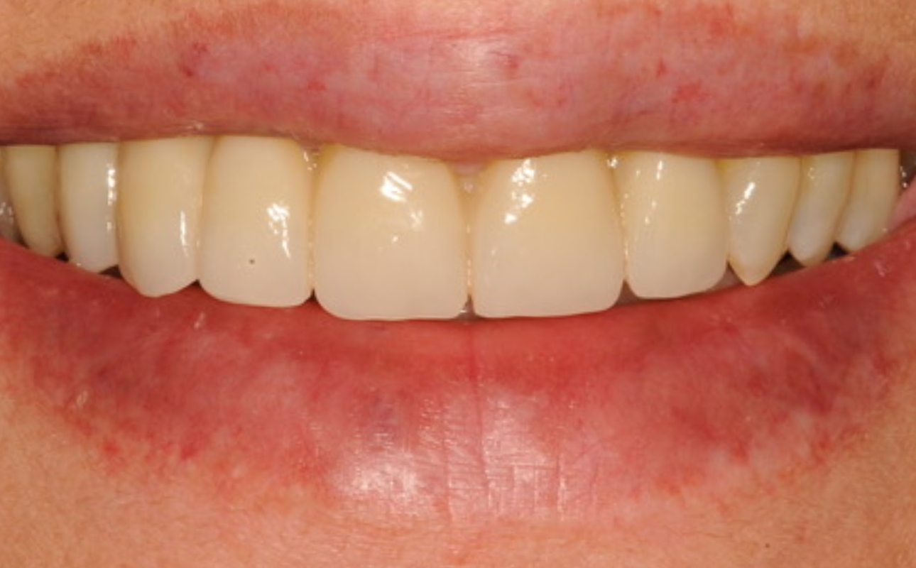 prima-e-dopo-studio-dentistico-lattanzi (2)